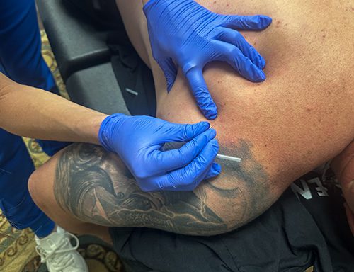 dry_needling_180_wellness_dallas